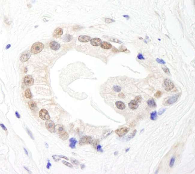 BRF1 Antibody - Detection of Human BRF1 by Immunohistochemistry. Sample: FFPE section of human prostate carcinoma. Antibody: Affinity purified rabbit anti-BRF1 used at a dilution of 1:200 (1 ug/ml).