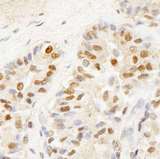 BRF1 Antibody - Detection of Human BRF1 by Immunohistochemistry. Sample: FFPE section of human prostate carcinoma. Antibody: Affinity purified rabbit anti-BRF1 used at a dilution of 1:100.