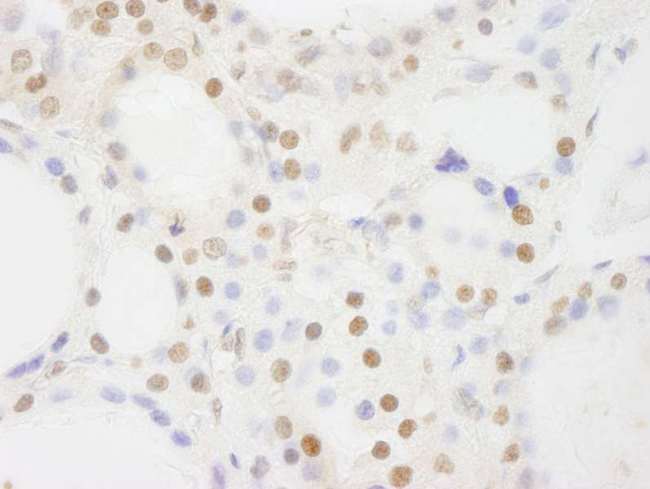 BRF1 Antibody - Detection of Human BRF1 by Immunohistochemistry. Sample: FFPE section of human thyroid carcinoma. Antibody: Affinity purified rabbit anti-BRF1 used at a dilution of 1:500.