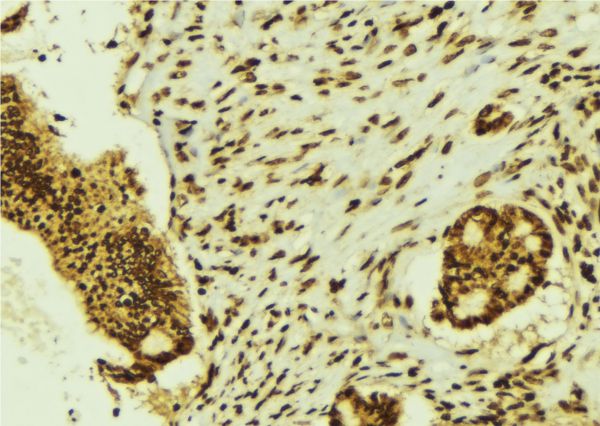 BRF1 Antibody - 1:100 staining human breast carcinoma tissue by IHC-P. The sample was formaldehyde fixed and a heat mediated antigen retrieval step in citrate buffer was performed. The sample was then blocked and incubated with the antibody for 1.5 hours at 22°C. An HRP conjugated goat anti-rabbit antibody was used as the secondary.