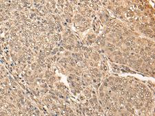 BRF2 Antibody - Immunohistochemistry of paraffin-embedded Human liver cancer tissue  using BRF2 Polyclonal Antibody at dilution of 1:40(×200)