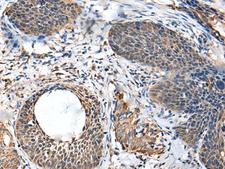 BRI3BP Antibody - Immunohistochemistry of paraffin-embedded Human cervical cancer tissue  using BRI3BP Polyclonal Antibody at dilution of 1:35(×200)