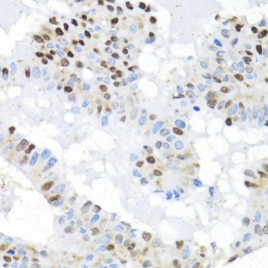 BRIP1 / BACH1 Antibody - Immunohistochemistry of paraffin-embedded Human breast cancer using BACH1 Polyclonal Antibody at dilution of 1:100 (40x lens).