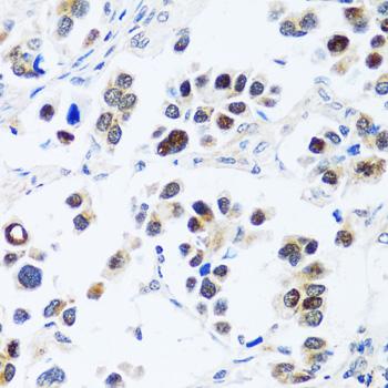 BRIX1 Antibody - Immunohistochemistry of paraffin-embedded Human lung cancer using BRIX1 Polyclonal Antibody at dilution of 1:100 (40x lens).