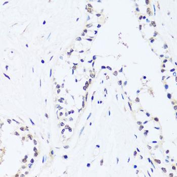 BRIX1 Antibody - Immunohistochemistry of paraffin-embedded Human breast using BRIX1 Polyclonal Antibody at dilution of 1:100 (40x lens).