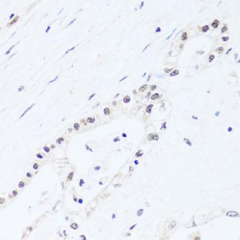 BRIX1 Antibody - Immunohistochemistry of paraffin-embedded Human gastric cancer using BRIX1 Polyclonal Antibody at dilution of 1:100 (40x lens).