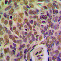 BRMS1 Antibody - Immunohistochemical analysis of BRMS1 staining in human breast cancer formalin fixed paraffin embedded tissue section. The section was pre-treated using heat mediated antigen retrieval with sodium citrate buffer (pH 6.0). The section was then incubated with the antibody at room temperature and detected using an HRP conjugated compact polymer system. DAB was used as the chromogen. The section was then counterstained with hematoxylin and mounted with DPX.