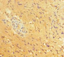 BRN2 / POU3F2 Antibody - Immunohistochemistry of paraffin-embedded human glioma cancer at dilution of 1:100
