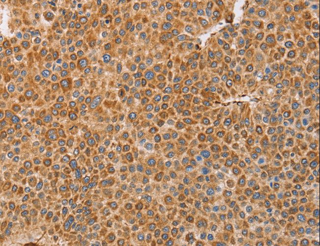BRS3 Antibody - Immunohistochemistry of paraffin-embedded Human cervical cancer using BRS3 Polyclonal Antibody at dilution of 1:30.
