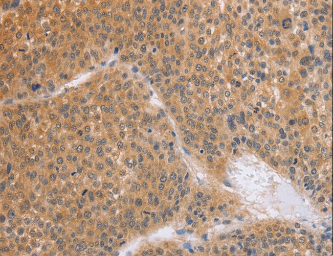 BRS3 Antibody - Immunohistochemistry of paraffin-embedded Human liver cancer using BRS3 Polyclonal Antibody at dilution of 1:50.