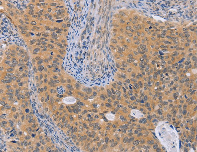 BRS3 Antibody - Immunohistochemistry of paraffin-embedded Human cervical cancer using BRS3 Polyclonal Antibody at dilution of 1:50.