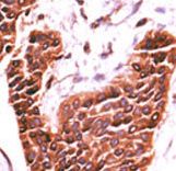 BRSK2 Antibody - Formalin-fixed and paraffin-embedded human cancer tissue reacted with the primary antibody, which was peroxidase-conjugated to the secondary antibody, followed by DAB staining. This data demonstrates the use of this antibody for immunohistochemistry; clinical relevance has not been evaluated. BC = breast carcinoma; HC = hepatocarcinoma.