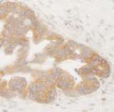 BRUCE / BIRC6 Antibody - Detection of Human BIRC6/Apollon by Immunohistochemistry. Sample: FFPE section of human ovarian tumor. Antibody: Affinity purified rabbit anti-BIRC6/Apollon used at a dilution of 1:250.