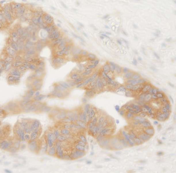 BRUCE / BIRC6 Antibody - Detection of Human BIRC6/Apollon by Immunohistochemistry. Sample: FFPE section of human ovarian tumor. Antibody: Affinity purified rabbit anti-BIRC6/Apollon used at a dilution of 1:250.