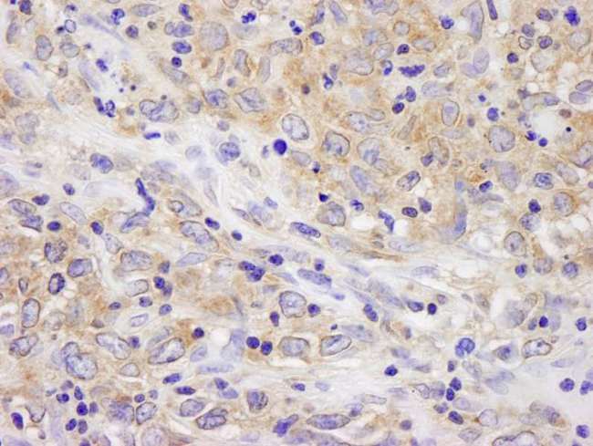 BRUCE / BIRC6 Antibody - Detection of Human BIRC6/Apollon by Immunohistochemistry. Sample: FFPE section of human metastatic lymph node. Antibody: Affinity purified rabbit anti-BIRC6/Apollon used at a dilution of 1:250.