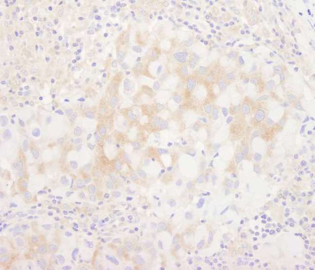 BRUCE / BIRC6 Antibody - Detection of Human BIRC6/Apollon by Immunohistochemistry. Sample: FFPE section of human breast carcinoma. Antibody: Affinity purified rabbit anti-BIRC6/Apollon used at a dilution of 1:5000 (0.2 ug/ml).