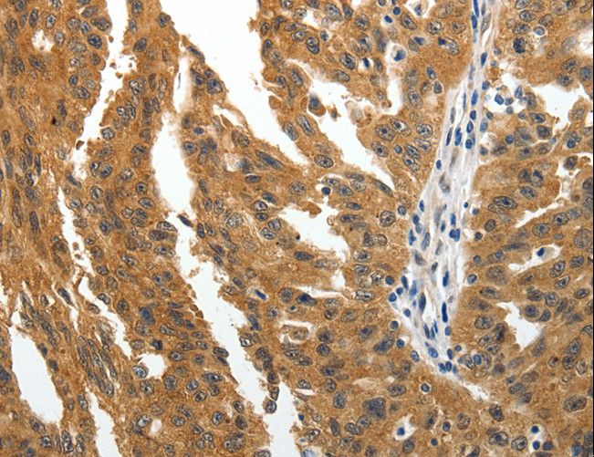 BRUCE / BIRC6 Antibody - Immunohistochemistry of paraffin-embedded Human ovarian cancer using BIRC6 Polyclonal Antibody at dilution of 1:30.
