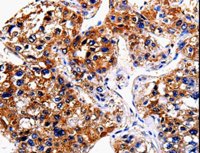BRUCE / BIRC6 Antibody - Immunohistochemistry of paraffin-embedded Human liver cancer using BIRC6 Polyclonal Antibody at dilution of 1:50.