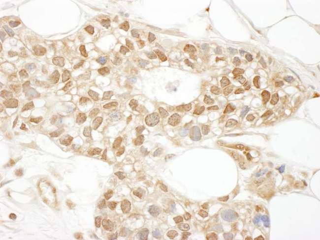 BSAC / MKL1 Antibody - Detection of Human MKL1 by Immunohistochemistry. Sample: FFPE section of human breast carcinoma. Antibody: Affinity purified rabbit anti-MKL1 used at a dilution of 1:200 (1 Detection: DAB.