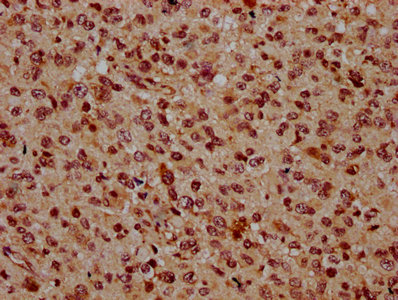 BSX Antibody - Immunohistochemistry Dilution at 1:500 and staining in paraffin-embedded human glioma cancer performed on a Leica BondTM system. After dewaxing and hydration, antigen retrieval was mediated by high pressure in a citrate buffer (pH 6.0). Section was blocked with 10% normal Goat serum 30min at RT. Then primary antibody (1% BSA) was incubated at 4°C overnight. The primary is detected by a biotinylated Secondary antibody and visualized using an HRP conjugated SP system.