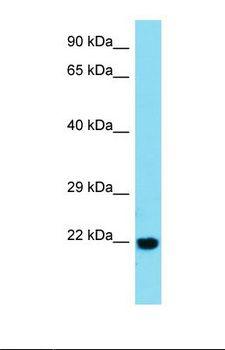 BTBD2 Antibody - Western blot of Human Esophagus Tumor. BTBD2 antibody dilution 1.0 ug/ml.  This image was taken for the unconjugated form of this product. Other forms have not been tested.