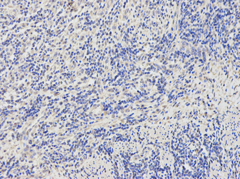 BTC / Betacellulin Antibody - Immunohistochemistry of paraffin-embedded human stomach cancer using BTC antibody at dilution of 1:200 (200x lens).