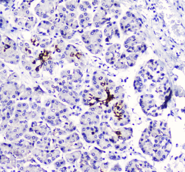 BTC / Betacellulin Antibody - IHC analysis of BTC using anti-BTC antibody. BTC was detected in paraffin-embedded section of human pancreatic cancer tissue. Heat mediated antigen retrieval was performed in citrate buffer (pH6, epitope retrieval solution) for 20 mins. The tissue section was blocked with 10% goat serum. The tissue section was then incubated with 1µg/ml rabbit anti-BTC Antibody overnight at 4°C. Biotinylated goat anti-rabbit IgG was used as secondary antibody and incubated for 30 minutes at 37°C. The tissue section was developed using Strepavidin-Biotin-Complex (SABC) with DAB as the chromogen.