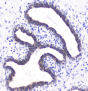 BTC / Betacellulin Antibody - IHC staining of FFPE human breast cancer with BTC antibody at 1ug/ml. HIER: boil tissue sections in pH6, 10mM citrate buffer, for 10-20 min followed by cooling at RT for 20 min.