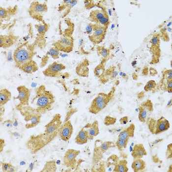 BTD / Biotinidase Antibody - Immunohistochemistry of paraffin-embedded human liver cancer tissue.