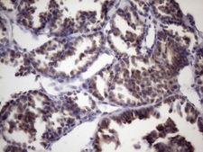 BTEB / KLF9 Antibody - Immunohistochemical staining of paraffin-embedded Human thyroid tissue within the normal limits using anti-KLF9 mouse monoclonal antibody. (Heat-induced epitope retrieval by 1mM EDTA in 10mM Tris buffer. (pH8.5) at 120 oC for 3 min. (1:150)
