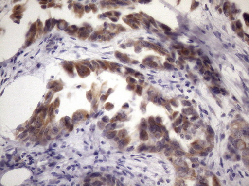 BTEB / KLF9 Antibody - Immunohistochemical staining of paraffin-embedded Adenocarcinoma of Human endometrium tissue using anti-KLF9 mouse monoclonal antibody. (Heat-induced epitope retrieval by 1mM EDTA in 10mM Tris buffer. (pH8.5) at 120 oC for 3 min. (1:150)
