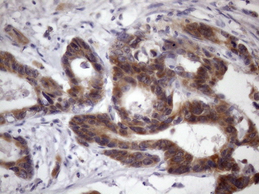 BTEB / KLF9 Antibody - Immunohistochemical staining of paraffin-embedded Adenocarcinoma of Human colon tissue using anti-KLF9 mouse monoclonal antibody. (Heat-induced epitope retrieval by 1mM EDTA in 10mM Tris buffer. (pH8.5) at 120 oC for 3 min. (1:150)