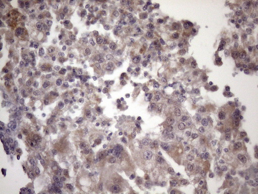 BTEB / KLF9 Antibody - Immunohistochemical staining of paraffin-embedded Carcinoma of Human kidney tissue using anti-KLF9 mouse monoclonal antibody. (Heat-induced epitope retrieval by 1mM EDTA in 10mM Tris buffer. (pH8.5) at 120 oC for 3 min. (1:150)