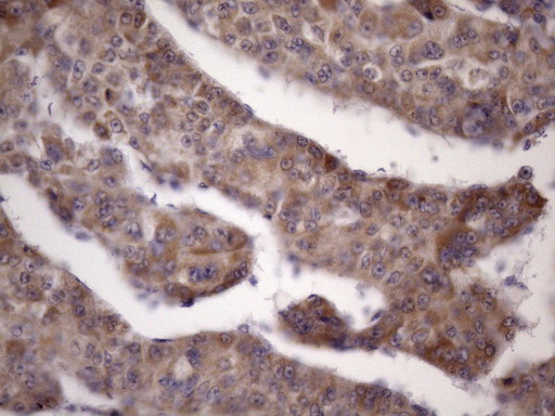 BTEB / KLF9 Antibody - Immunohistochemical staining of paraffin-embedded Carcinoma of Human liver tissue using anti-KLF9 mouse monoclonal antibody. (Heat-induced epitope retrieval by 1mM EDTA in 10mM Tris buffer. (pH8.5) at 120 oC for 3 min. (1:150)