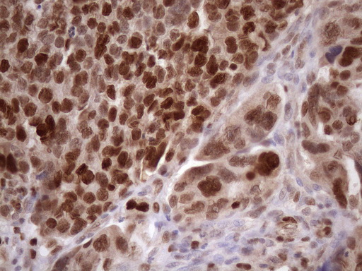 BTEB / KLF9 Antibody - Immunohistochemical staining of paraffin-embedded Adenocarcinoma of Human ovary tissue using anti-KLF9 mouse monoclonal antibody. (Heat-induced epitope retrieval by 1mM EDTA in 10mM Tris buffer. (pH8.5) at 120 oC for 3 min. (1:150)