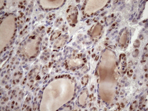BTEB / KLF9 Antibody - Immunohistochemical staining of paraffin-embedded Carcinoma of Human thyroid tissue using anti-KLF9 mouse monoclonal antibody. (Heat-induced epitope retrieval by 1mM EDTA in 10mM Tris buffer. (pH8.5) at 120 oC for 3 min. (1:150)