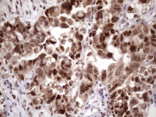 BTEB / KLF9 Antibody - Immunohistochemical staining of paraffin-embedded Adenocarcinoma of Human endometrium tissue using anti-KLF9 mouse monoclonal antibody. (Heat-induced epitope retrieval by 1mM EDTA in 10mM Tris buffer. (pH8.5) at 120 oC for 3 min. (1:150)