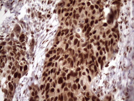 BTEB / KLF9 Antibody - Immunohistochemical staining of paraffin-embedded Carcinoma of Human kidney tissue using anti-KLF9 mouse monoclonal antibody. (Heat-induced epitope retrieval by 1mM EDTA in 10mM Tris buffer. (pH8.5) at 120 oC for 3 min. (1:150)