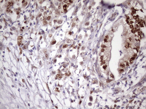 BTEB / KLF9 Antibody - Immunohistochemical staining of paraffin-embedded Carcinoma of Human pancreas tissue using anti-KLF9 mouse monoclonal antibody. (Heat-induced epitope retrieval by 1mM EDTA in 10mM Tris buffer. (pH8.5) at 120 oC for 3 min. (1:150)