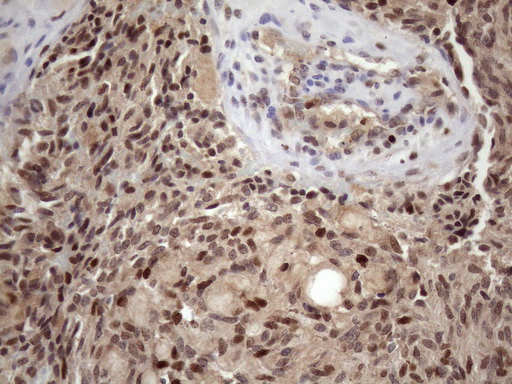 BTEB / KLF9 Antibody - Immunohistochemical staining of paraffin-embedded Human thyroid tissue within the normal limits using anti-KLF9 mouse monoclonal antibody. (Heat-induced epitope retrieval by 1mM EDTA in 10mM Tris buffer. (pH8.5) at 120 oC for 3 min. (1:150)
