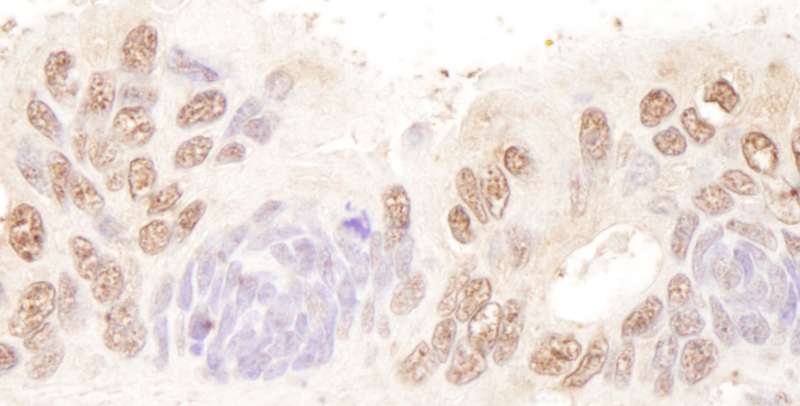 BTF / BCLAF1 Antibody - Detection of Human BTF by Immunohistochemistry. Sample: FFPE section of human ovarian carcinoma. Antibody: Affinity purified rabbit anti-BTF used at a dilution of 1:200 (1 ug/ml).