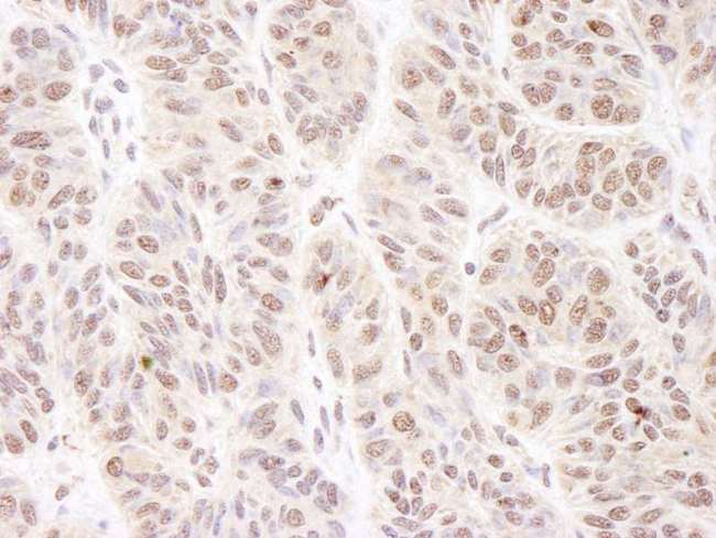 BTF / BCLAF1 Antibody - Detection of Human BTF by Immunohistochemistry. Sample: FFPE section of human skin carcinoma. Antibody: Affinity purified rabbit anti-BTF used at a dilution of 1:200 (1 ug/ml).