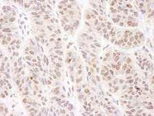 BTF / BCLAF1 Antibody - Detection of Human BTF by Immunohistochemistry. Sample: FFPE section of human skin carcinoma. Antibody: Affinity purified rabbit anti-BTF used at a dilution of 1:200 (1 ug/ml).