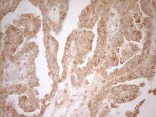 BTG1 Antibody - Immunohistochemical staining of paraffin-embedded Adenocarcinoma of Human ovary tissue using anti-BTG1 mouse monoclonal antibody. (Heat-induced epitope retrieval by 1 mM EDTA in 10mM Tris, pH8.5, 120C for 3min,