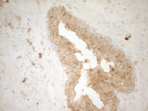 BTG1 Antibody - Immunohistochemical staining of paraffin-embedded Adenocarcinoma of Human endometrium tissue using anti-BTG1 mouse monoclonal antibody. (Heat-induced epitope retrieval by 1 mM EDTA in 10mM Tris, pH8.5, 120C for 3min,