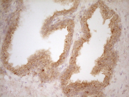 BTG1 Antibody - Immunohistochemical staining of paraffin-embedded Carcinoma of Human prostate tissue using anti-BTG1 mouse monoclonal antibody. (Heat-induced epitope retrieval by 1 mM EDTA in 10mM Tris, pH8.5, 120C for 3min,