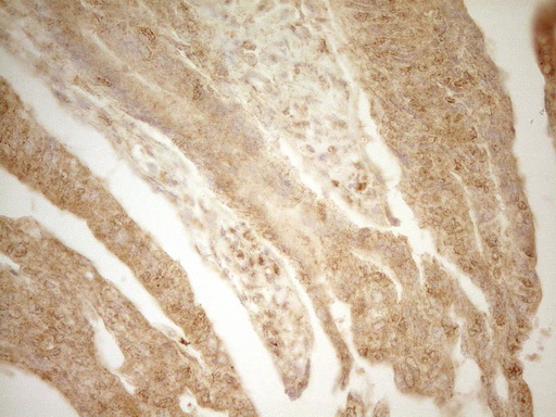 BTG1 Antibody - Immunohistochemical staining of paraffin-embedded Adenocarcinoma of Human colon tissue using anti-BTG1 mouse monoclonal antibody. (Heat-induced epitope retrieval by 1 mM EDTA in 10mM Tris, pH8.5, 120C for 3min,
