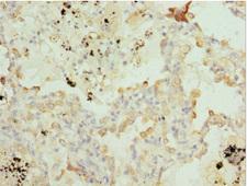 BTG1 Antibody - Immunohistochemistry of paraffin-embedded human lung cancer tissue at dilution 1:100