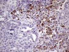 BTG2 Antibody - Immunohistochemical staining of paraffin-embedded Carcinoma of Human lung tissue using anti-BTG2 mouse monoclonal antibody. (Heat-induced epitope retrieval by 1 mM EDTA in 10mM Tris, pH8.5, 120C for 3min. (1:150)