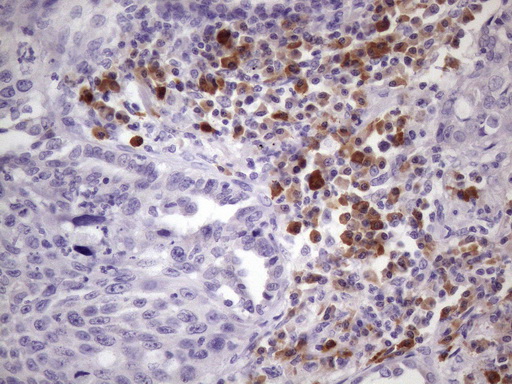 BTG2 Antibody - IHC of paraffin-embedded Carcinoma of Human lung tissue using anti-BTG2 mouse monoclonal antibody. (Heat-induced epitope retrieval by 1 mM EDTA in 10mM Tris, pH8.5, 120°C for 3min)(1:150).